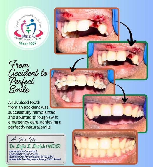 From Accident to Perfect Smile - dental case treated by Dr. Sajid S. Shaikh at Smile 4U, Kurla