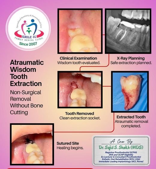 Atraumatic Wisdom Tooth Extraction - dental case treated by Dr. Sajid S. Shaikh at Smile 4U, Kurla