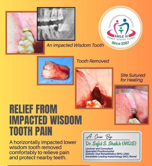 Relief from Impacted Wisdom Tooth Pain - dental case treated by Dr. Sajid S. Shaikh at Smile 4U, Kurla