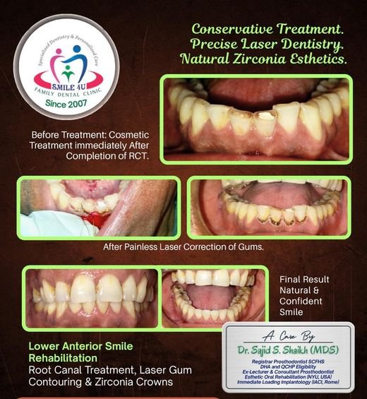 Lower Anterior Smile Rehabilitation - dental case treated by Dr. Sajid S. Shaikh at Smile 4U, Kurla