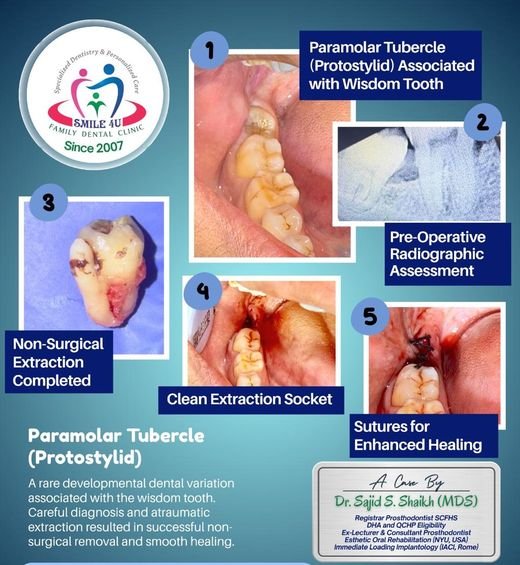 Paramolar Tubercle (Protostylid) - dental case treated by Dr. Sajid S. Shaikh at Smile 4U, Kurla