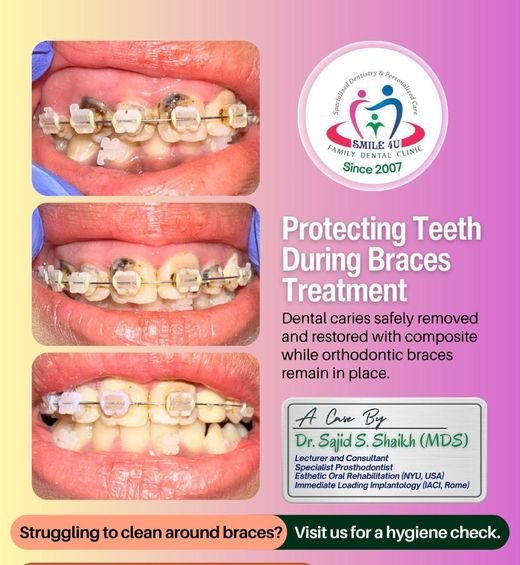 Protecting Teeth During Braces Treatment - dental case treated by Dr. Sajid S. Shaikh at Smile 4U, Kurla