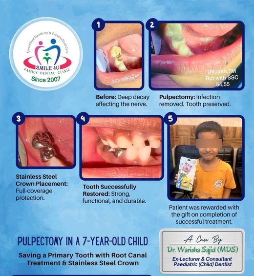 Pulpectomy in a 7-Year-Old Child - dental case treated by Dr. Warisha Shaikh at Smile 4U, Kurla