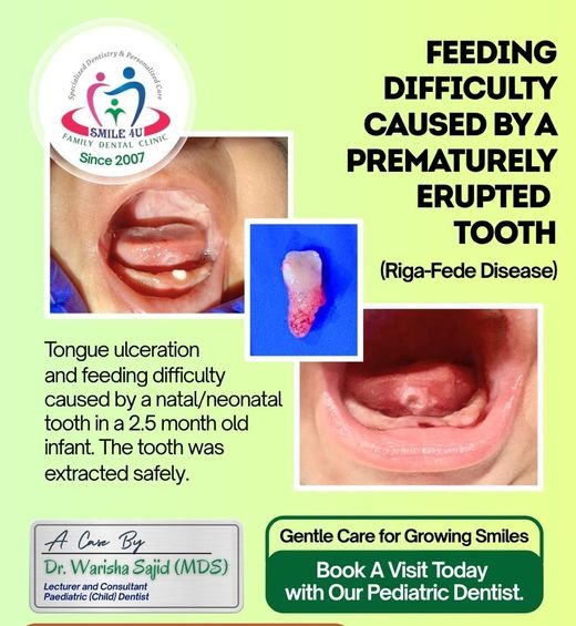 Feeding Difficulty from a Prematurely Erupted Tooth - dental case treated by Dr. Warisha Shaikh at Smile 4U, Kurla