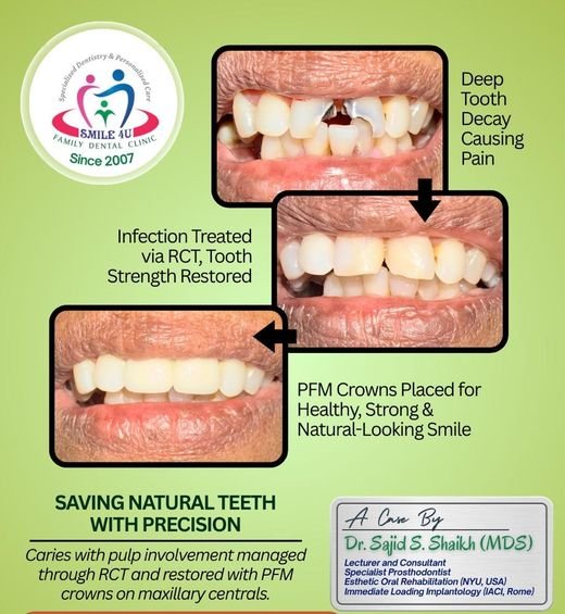 Saving Natural Teeth with Precision - dental case treated by Dr. Sajid S. Shaikh at Smile 4U, Kurla