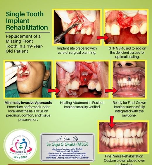 Single Tooth Implant Rehabilitation - dental case treated by Dr. Sajid S. Shaikh at Smile 4U, Kurla