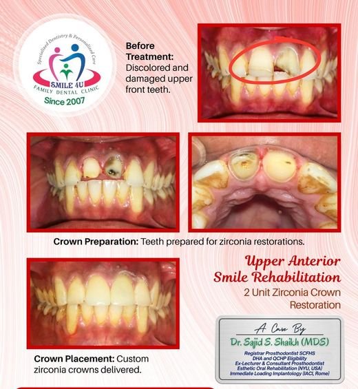 Upper Anterior Smile Rehabilitation - dental case treated by Dr. Sajid S. Shaikh at Smile 4U, Kurla