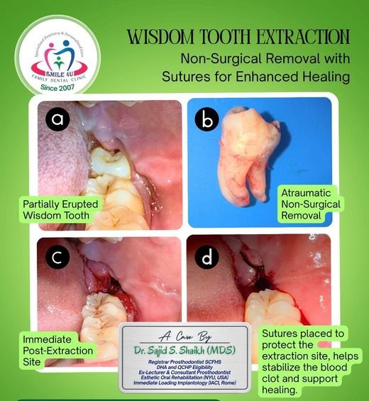 Wisdom Tooth Extraction with Sutures - dental case treated by Dr. Sajid S. Shaikh at Smile 4U, Kurla