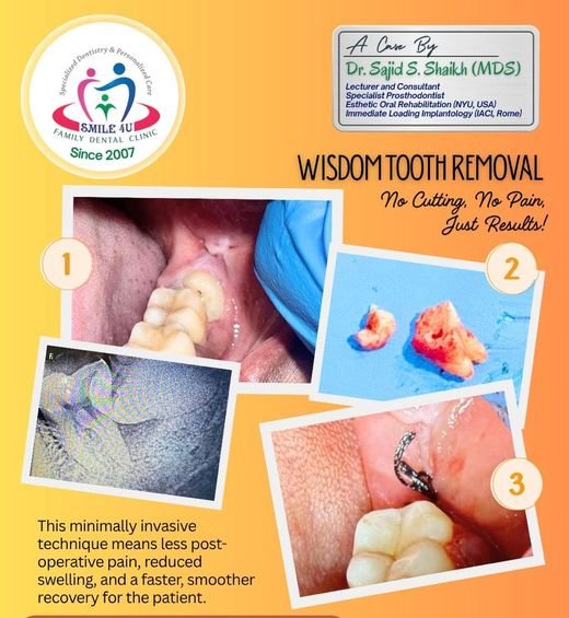 Wisdom Tooth Removal, No Cutting, No Pain - dental case treated by Dr. Sajid S. Shaikh at Smile 4U, Kurla
