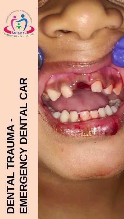 Dental Trauma, Emergency Dental Care - treatment video at Smile 4U Family Dental Clinic, Kurla