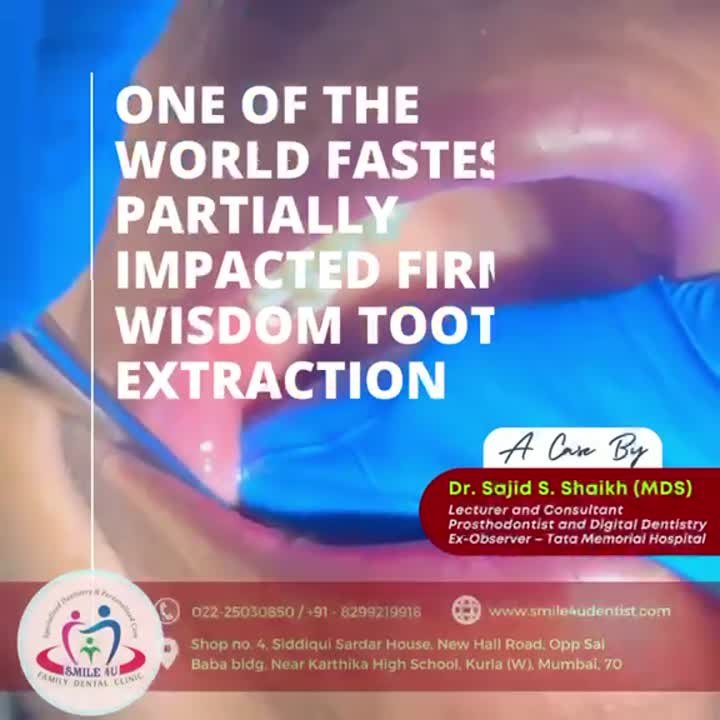 Partially Impacted Wisdom Tooth Extraction - treatment video at Smile 4U Family Dental Clinic, Kurla
