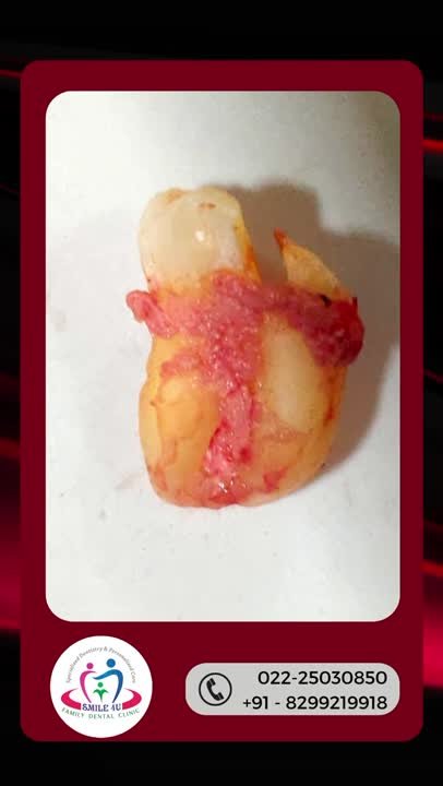 Wisdom Tooth Extraction - treatment video at Smile 4U Family Dental Clinic, Kurla