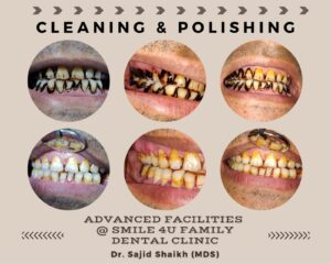 teeth cleaning in Kurla, Mumbai