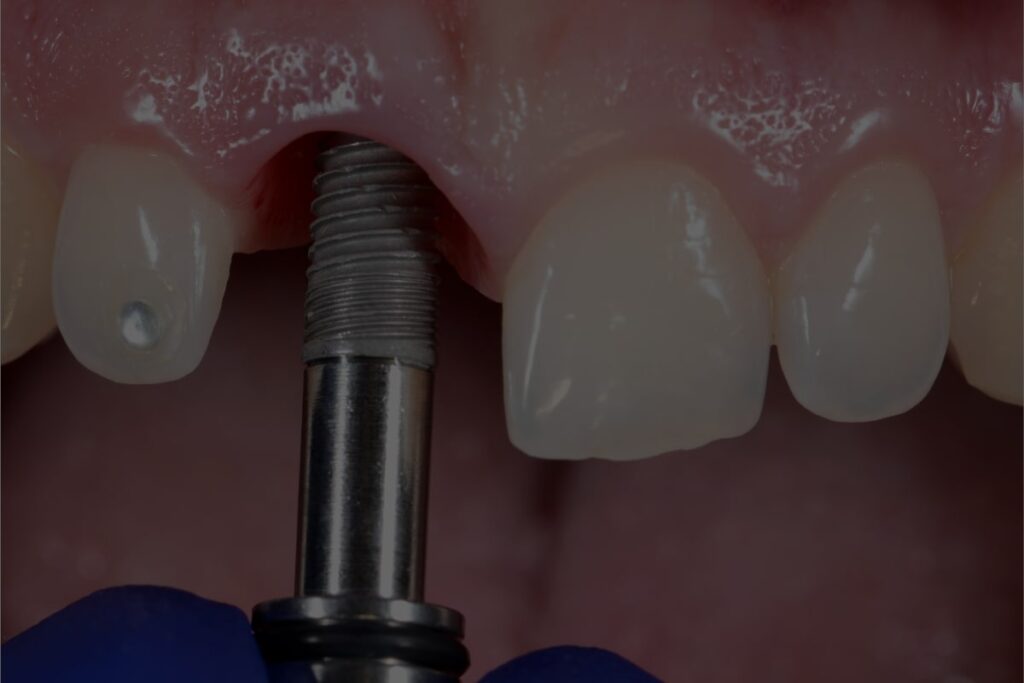 Can the implant be placed and my tooth removed on the same day?