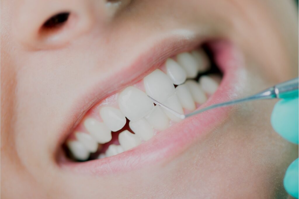 In Kurla, Mumbai, Here Are 5 Things You Should Know About Dental Cleaning