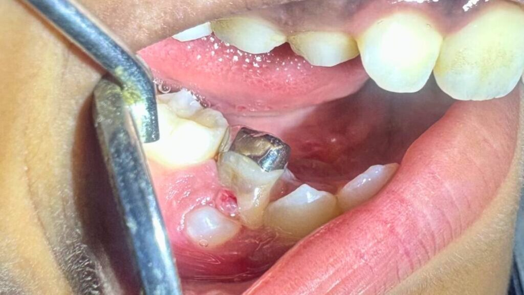 Saving Smiles (A Case) – A Triumph in Primary Molar Root Canal Treatment