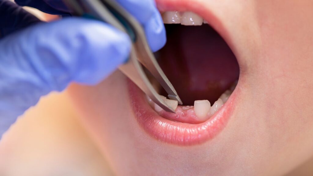 Why is the treatment of milk teeth important?