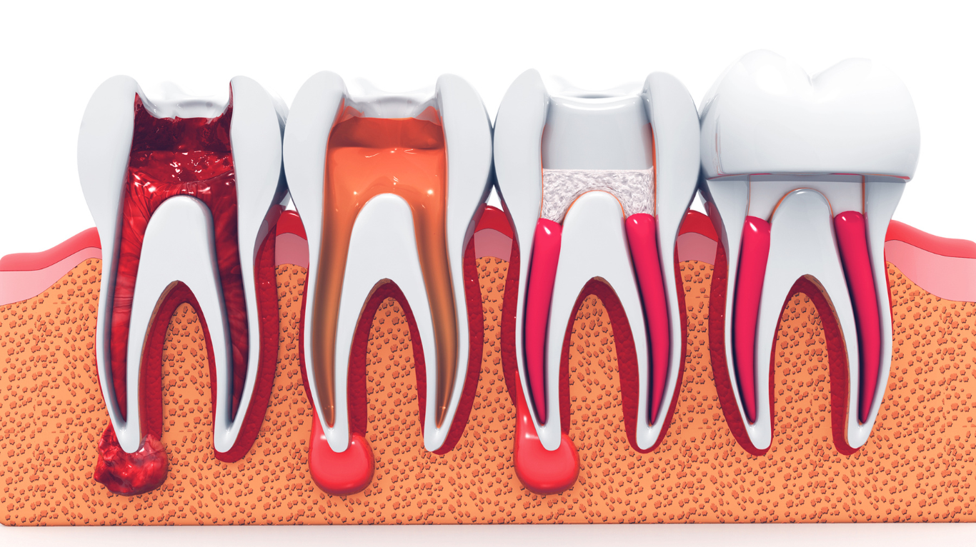 Understanding Root Canal Therapy: Myths vs. Facts
